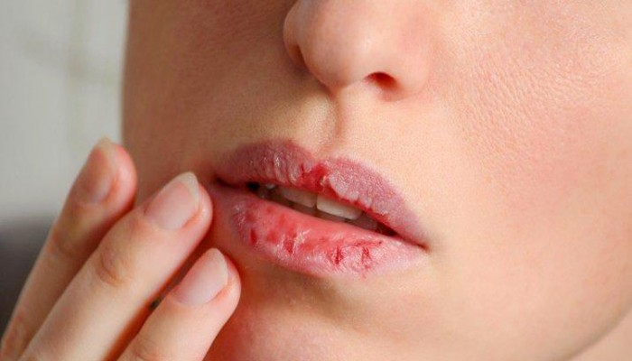 শীতে ঠোঁট ফাটা রোধ করবেন যেভাবে